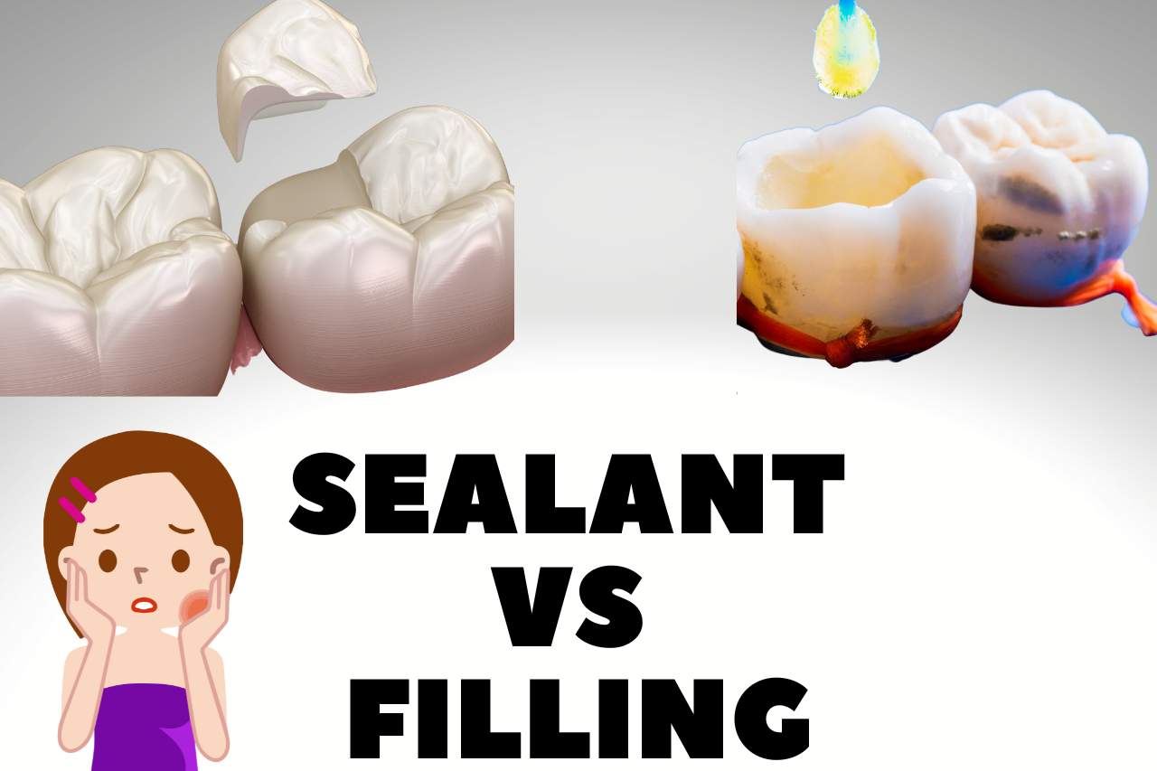 sealant vs filling